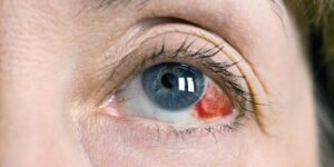 Кровоподтек в глазу: причины и лечение. Сколько проходит кровоподтек в глазу