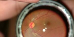 Офтальмоскопия глазного дна: виды, показания, как проводится