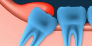 Перикоронит: лечение в стоматологии и в домашних условиях