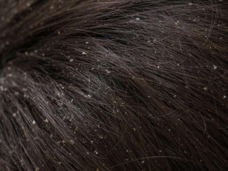 Заболевания волос: обзор самых распространенных, причины, симптомы и методы лечения